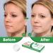 TUHIMO Pimple Patch Removal Device Pimple Remover for All Skin Types Herbal Condensed Patch for Small Large Pimples Wart - 72 Patches Bioclear Skin Tag Remover 1.0 count - Buy Online on GoSupps.com