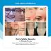 Upgrade Skin Tag Remover Kit for Men & Women - 36 Skin Shields & Repair Lotion - Safe and Effective Skin Tag and Mole Corrector Set - Buy Online on GoSupps.com