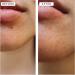 DIME Beauty Power Patch Acne Pimple Spot Treatment | Salicylic Acid, Vitamin A & Clove Oil | Vegan & Cruelty-Free | 48 Count - Buy Online on GoSupps.com