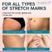 Stretch Mark Cream - Maternity Skin Care with Collagen, Jojoba, and Olive Oil - Prevents and Fades Stretch Marks - Hydrating Belly Lotion for Pregnant Women - 4 oz - Buy Online on GoSupps.com