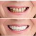 5-Piece Snap-On Cosmetic Dentures | Perfect Smile Tooth Replacement | Comfort-Fit Flex Teeth Whitening for Beautiful Neat Results - Buy Online on GoSupps.com
