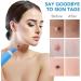 JIAWEIIY 2-in-1 Auto Skin T_ag Removal Kit for Skin T_ag (2-8mm) Skin T_ag Remover Device for Skin T_ags Fast and Easy Skin T_ag Remover Pen Device - Buy Online on GoSupps.com