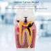 Tooth Caries Model - 6x Enlarged Caries Demonstration for Dental Education | International Shipping - Buy Online on GoSupps.com