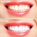 Silicone Bite Track Tooth Bleaching Gear | Teeth Protection Splint for Grinding & Sports | Mouth Guard for Whitening - Buy Online on GoSupps.com