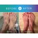 Prosoria Psoriasis Treatment System - Clinical Strength with Natural Botanicals | Soften, Restore & Treat Skin | 2 Fl Oz (Pack of 2) - Buy Online on GoSupps.com