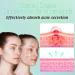 Star Pimple Patches for Acne - 240 Count Hydrocolloid Dots with Tea Tree Oil | 3 Sizes & 6 Colors - Buy Online on GoSupps.com