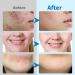 Glycolic Acid Pads 2PCS 10% Advanced Pure Glycolic Acid & 2% Salicylic Acid Exfoliating Peel 80 Pads for Face with Deep Cleaning Effect Reduces Blackheads Keeps Skin Smooth - Buy Online on GoSupps.com