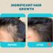 IVACHI Hair Booster Serum - Natural Way To Achieve Healthy Hair Growth & Hair Fall Protection As Soon As 60 Days | For All Hair Types 30ml - Buy Online on GoSupps.com