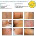 Aroamas Silicone Scar Sheets - Soften & Flatten Scars from Surgery, Burns, C-Section | 8 Sheets - 4 Month Supply - Buy Online on GoSupps.com