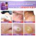 Dr. DERM Maximum Strength Wart Remover Liquid Gel - Fast-Acting Treatment for Plantar, Genital, Corn, Common, and Flat Warts - Natural and Safe Formula - 0.5 Fl Oz - Buy Online on GoSupps.com