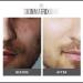 YISHIQI Anti-Blemish Acne Control Pads - Salicylic Lactic & Mandelic Acid for Effective Acne Treatment - Clear Clogged Pores & Eliminate Pimples on Face & Body - Buy Online on GoSupps.com