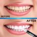 VS1 Teeth Whitening Kit - No Sensitivity - 3 Whitening Pens, LED Light - 36% Carbamide Peroxide - Fast Results in 10 Minutes - Buy Online on GoSupps.com