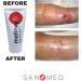 Sanomed Melloxy Wound & Healing Ointment 50g - Natural Gel for Acute Wounds Eczema & Fissured Skin - Medical Honey & Ozonized Olive Oil - Buy Online on GoSupps.com