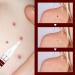Wipe Off Tags and Mole Remover Skin Tag Remover & Mole Remover for Face Armpit Flesh Neck - Buy Online on GoSupps.com