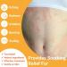 Buy Tinea Versicolor Treatment - Effective Antifungal Cream for Ringworm & Skin Irritation | 3.53 Oz - Buy Online on GoSupps.com