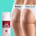 Ebanel Silicone Scar Gel with Onion Extract, Emu Oil, Vitamin E - Medical-Grade Cream for Scar Removal & Stretch Marks - Acne, Burn, Surgical Scars, Injuries, C-Section, Insect Bites - Buy Online on GoSupps.com
