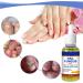Nail Fungal Treatment Toenail Treatment Extra Strong Nail Repair Set Fingernail Toenail Care Fix Renew Damaged Broken Anti Fungus Nail Repair - Buy Online on GoSupps.com