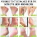 Urea 42% Foot Cream Cracked Heel Repair Cream For Feet and Hand Callus Remover For Dry And Hard Skin Hydrating Foot Moisterizer Nourishes Soften for Feet Knees Hand 100g - Buy Online on GoSupps.com