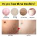 Best Stretch Marks Cream for Scar Removal | Repair & Reduce Skin Stripes - 30g - Buy Online on GoSupps.com