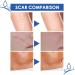3PCS Scar Removal Gel - Medical Grade Lotion for All Scars & Stretch Marks - Buy Online on GoSupps.com