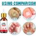 Fungal Nail Treatment for Toenail Toe Nail Fungal Treatment Anti Fungus Nail Repair and Strengthen Toenail Fungus Treatment Fungal Nail Drop Fix and Renew Damaged Cure Nail Fungus Restoring Nails - Buy Online on GoSupps.com