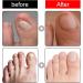 Ingrown Toenail & Fungal Nail Treatment Drops 10ML - Nail Care to Strengthen & Renew Damaged Nails - Buy Online on GoSupps.com