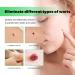 Wart Removal Soap for Face and Neck - Soap for Removing Warts Skin Tags and Moles - Natural Ingredients - Buy Online on GoSupps.com