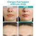 Buy Microdart Blemish Patches - 27 Fast Acting Zit Patches for Cystic Acne - Infused with Hyaluronic Acid & Tea Tree - International Shipping Available - Buy Online on GoSupps.com