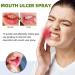 Mouth Ulcer Treatment Spray Mouth Ulcer Spray Mouth Ulcer Relief Spray Canker Sore Treatment Ulcer Treatment Tongue Breath Spray for Bad Breath Ulcer Treatment Canker Relief Spray Mouth Freshener - Buy Online on GoSupps.com