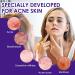 Halercay 20g acne cream reduces the volume of pimples effectively improves pimples on the face removes acne for pimpleprone skin makes the skin look smooth - Buy Online on GoSupps.com