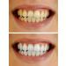 Teeth Whitening Gel 10ml Syringe 44% Carbamide Peroxide - 4 Pack - Buy Online on GoSupps.com