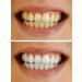 Teeth Whitening Gel 35% Carbamide Peroxide Professional Dispenser - 3 Pack (30ml each) - Buy Online on GoSupps.com