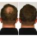 Natural Keratin Hair Fibre Refill for Hair Loss - 25g Grey (Pack of 1) | For Alopecia & Chemotherapy - Buy Online on GoSupps.com