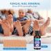 AUSLKA Toenail Fungus Treatment | Nail Renewal Solution for Discolored & Damaged Nails (32 Patches + 1 FL/OZ) - Fast & Easy Repair - Buy Online on GoSupps.com