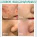 Salicylic Acid Face Moisturizer - Face Cream for Women - Acne Repair Face Cream - Spot Cream for Acne & Pimple - Moisturizer Face with Salicylic Acid - Improves Acne & Brightens Skin 20g - Buy Online on GoSupps.com