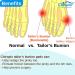 Chiroplax Tailor's Bunion Corrector Pads - Pain Relief Pinky Toe Straightener Separator Kit - Buy Online on GoSupps.com