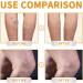 EXQST Fivfivgo Varicose Veins Miracle Cream Varicose Veins Treatment Cream Improves Circulation - Buy Online on GoSupps.com