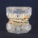 Dental Teeth Model with Metal Brackets - Orthodontic PVC Resin for Dental Schools - Buy Online on GoSupps.com