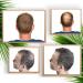  VIDALFORCE Volumizing thickening powder for hair - Baldness hair loss & roots - Natural keratin microfibers. Hair loss concealer | Medium Brown (Fixer + Fibers) | - Buy Online on GoSupps.com