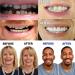 Hfdhd Instant Cosmetic Dentures - Comfortable Silicone Temporary Teeth for Men & Women | 9 Pairs Removable Tooth Prosthesis - Buy Online on GoSupps.com