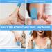 iKeener Laser Fungus Treatment Device - Buy Online on GoSupps.com