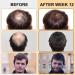 Buy Hair Growth Foam for Men & Women | With Biotin & Capilia Longa | Effective Hair Regrowth Treatment for Thicker Stronger Hair | Stop Hair Thinning - Buy Online on GoSupps.com