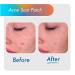 Fazit Acne Scar Treatment Patches - 24 Individual Patches for Face Bikini & Body - Effective Acne Scar Remover - Buy Online on GoSupps.com