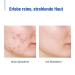 Buy AKNEDERM CREME 2x30g - Anti Pimple Zinc Cream for Acne Treatment - Vegan & Fragrance-Free - Intensive Care for Blemishes - International Shipping Available - Buy Online on GoSupps.com