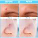 Acne Pimple Micropoint Patches - 18 Count (2 Packs) | Best Spot Treatment for Inflamed Cystic Acne and Hormonal Breakouts - Buy Online on GoSupps.com