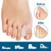 Sumifun Bunion Corrector - 10 Pack Bunion Cushion Protectors with Toe Separator for Bunion Pain, Calluses, Corns - Buy Online on GoSupps.com