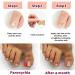 Fertoe Toenail Corrector Patch - 100pcs Ingrown Toenail Correction Strips for Painless Pedicure - Buy Online on GoSupps.com