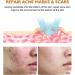 Anti-acne cream adolescent acne treatment herbal essence acne elimination various acne intensity antibacterial inhibition acne growth repair facial skin herbal acne essence treatment - Buy Online on GoSupps.com