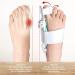 Bunion Valgus Corrector - Adjustable Day Night Orthopedic Toe Straightener (White) - Buy Online on GoSupps.com