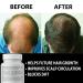 Finanutride Natural DHT Blocker Capsules for Hair Growth & Loss Prevention - Stimulate Follicles, Stop Loss, Regrow Hair - Anti-Hair Loss Treatment & Vitamin Supplement - Buy Online on GoSupps.com